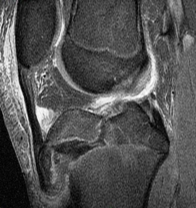 Figure 2 for case Salter type IV fracture ( RID4688 )